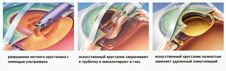 Этапы операции удаления катаракты факоэмульсификация
