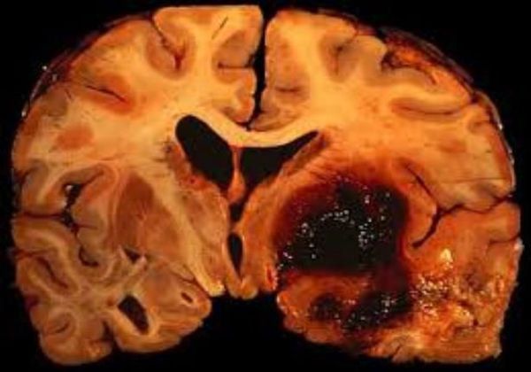 Ишемическое и геморрагическое поражение мозга на макропрепарате