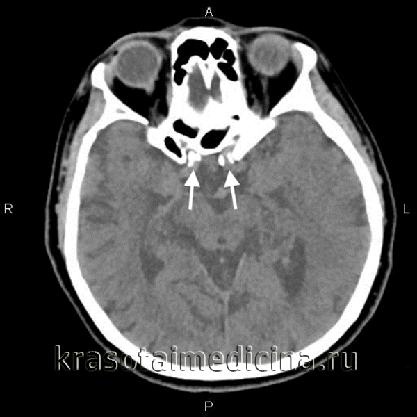 КТ головного мозга. На уровне турецкого седла выраженное атеросклеротическое обызвествление стенок интракраниальных сонных артерий с обеих сторон