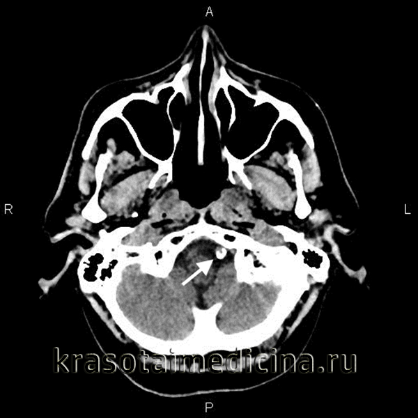 КТ головного мозга. Обызвествление стенки интракраниальной части левой позвоночной артерии