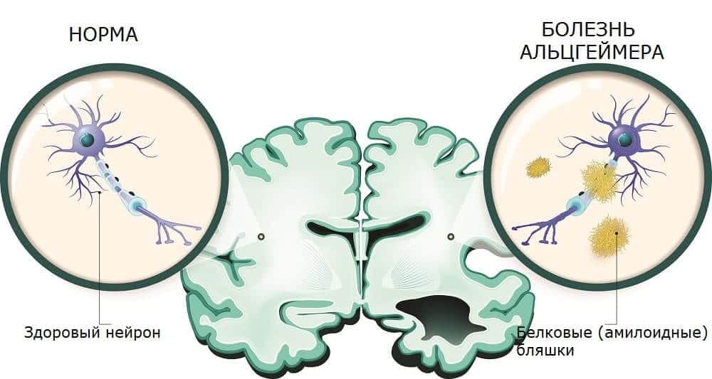 Накопление амилоида в нейронах вызывает Альцгеймера