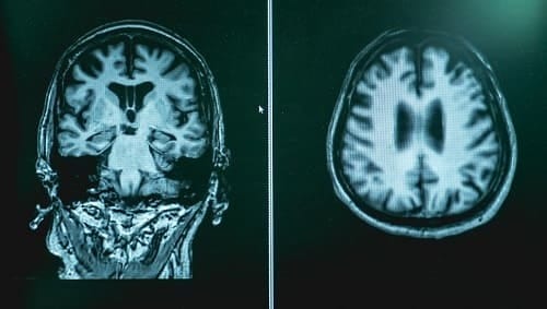 МРТ мозга, пораженного Альцгеймером